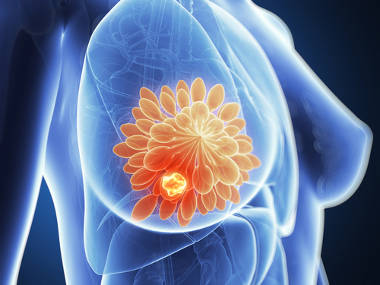 Австралийские ученые разработали новый тест для диагностики рака молочной железы