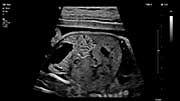 Уважаемые коллеги! Приглашаем вас принять участие в онлайн-трансляции сателлитного симпозиума «Как правильно выполнить скрининг сердца плода в I, II и III триместрах беременности, чтобы избежать фатальных ошибок?»